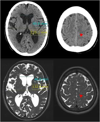 Fluid Distribution Pattern in Adult-Onset Congenital, Idiopathic, and Secondary Normal-Pressure Hydrocephalus: Implications for Clinical Care